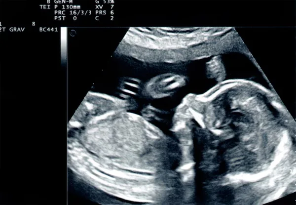 Multiple Pregnancy Scan